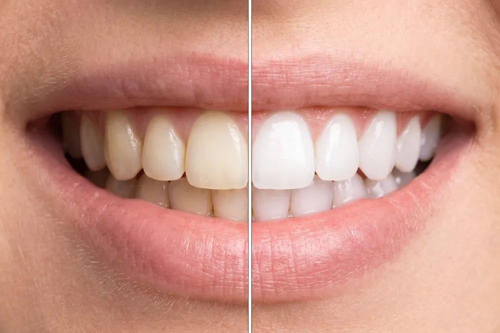 Before and after smile