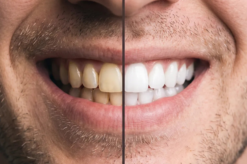 Even bright smile including dental work