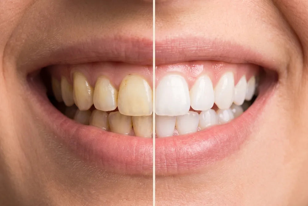 Before and after: yellow tone neutralized