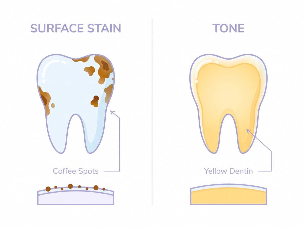 Diagram: a surface stain sitting on the enamel versus an even warm tone from dentin showing through
