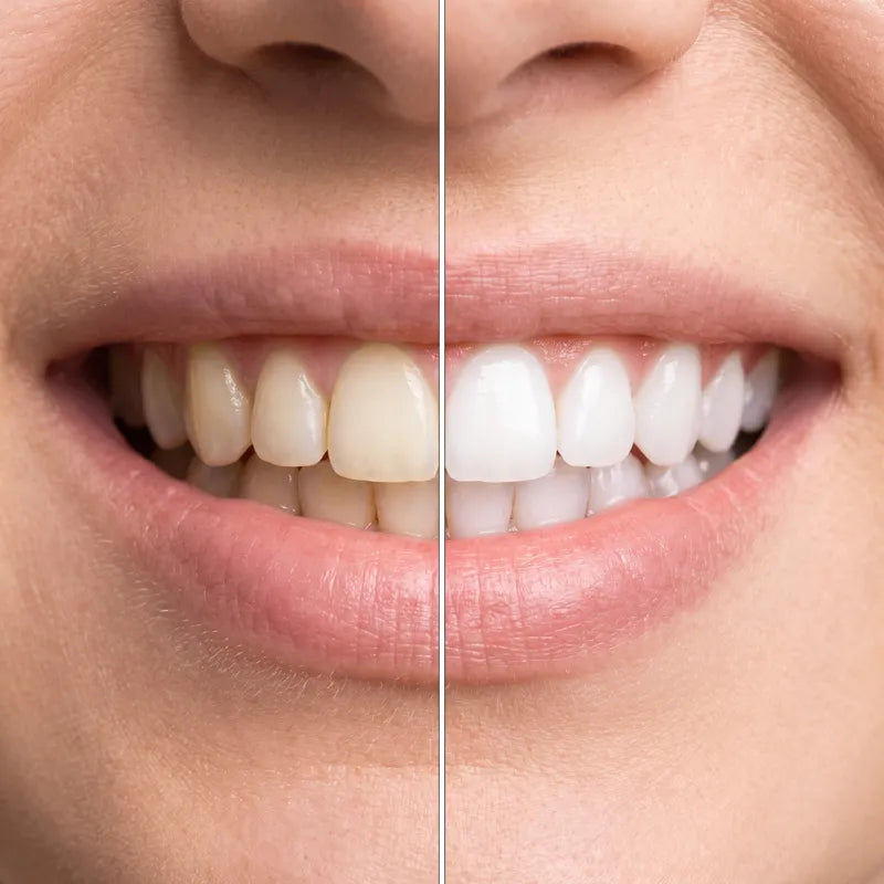Before and after smile result