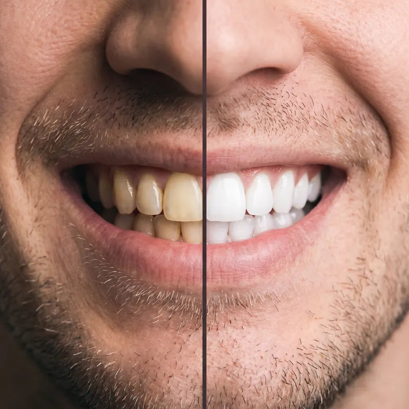 Before and after smile result